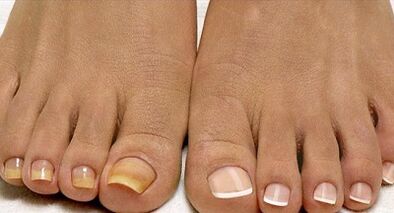 Методи за лечение на гъбички на флота