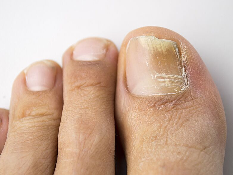 Първоначалният етап на гъбичката